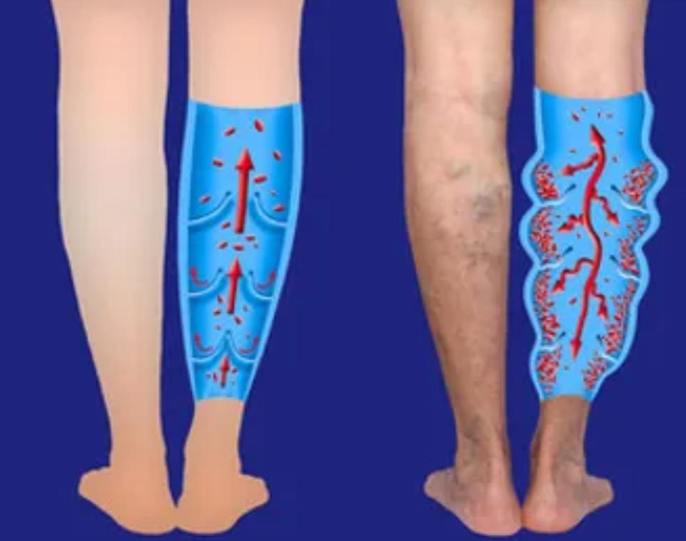 VenoCare